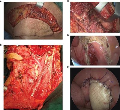 Flap Reconstruction of the Oropharyngeal Defect After Tumor Resection via Combined Transcervical and Transoral Approach in Patients With HPV-Positive and -Negative Oropharyngeal Squamous Cell Carcinoma